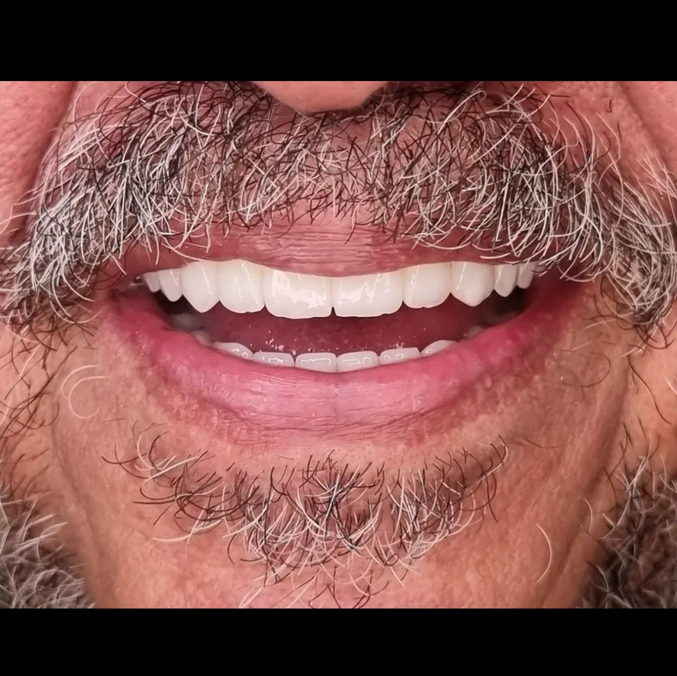 Caso clínico de implante dentário realizado na Neoclin