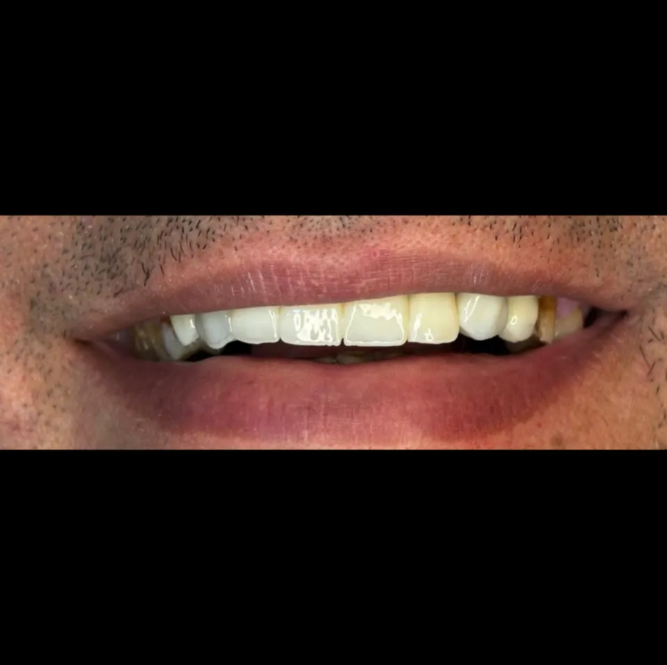 Resultado final de reabilitação oral realizada na Neoclin