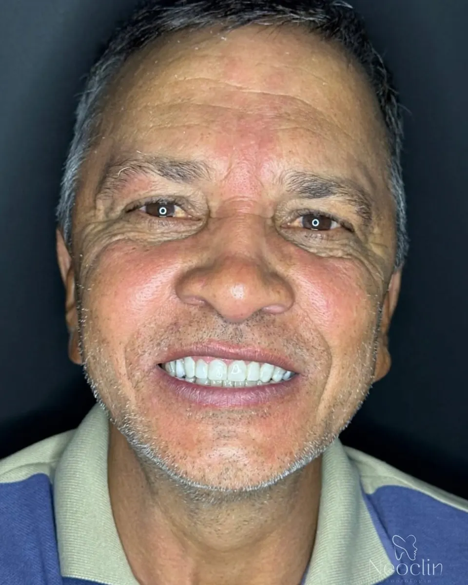 Caso clínico de estética dental realizado na Neoclin