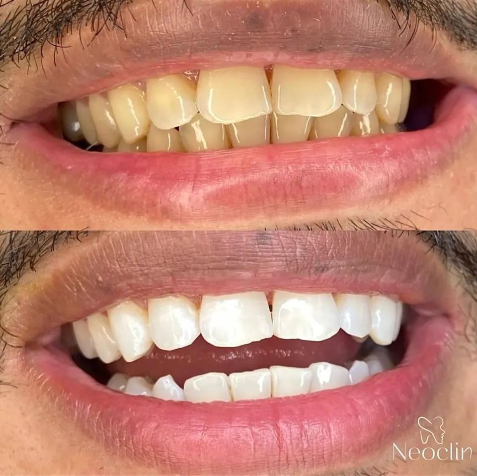 Caso clínico de reabilitação dental realizado na Neoclin